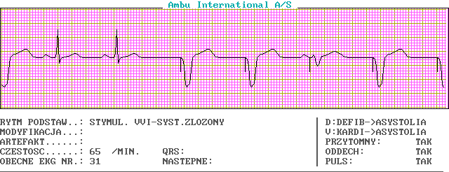 EKG wykresy z łyżek, Pierwsza Pomoc - c31-0.png